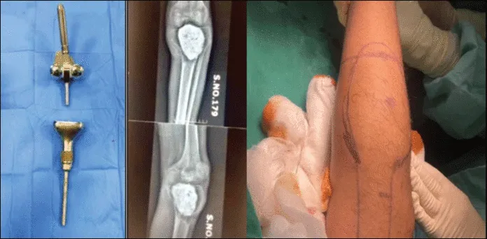 Pakistan’s First Knee Cancer Surgery: Jinnah Hospital Saves Young Man’s Life with Free Treatment